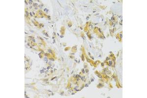 Immunohistochemistry of paraffin-embedded human breast cancer using EIF4G1 Antibody. (EIF4G1 Antikörper)