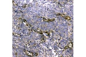 IHC testing of FFPE human lung cancer tissue with MYBPC3 antibody at 1ug/ml. (MYBPC3 Antikörper)