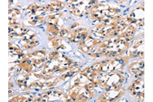 The image on the left is immunohistochemistry of paraffin-embedded Human thyroid cancer tissue using ABIN7189861(APOL6 Antibody) at dilution 1/50, on the right is treated with synthetic peptide. (APOL6 Antikörper)