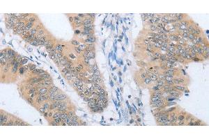 Immunohistochemistry of paraffin-embedded Human colon cancer tissue using CHRNA10 Polyclonal Antibody at dilution 1:50 (CHRNA10 Antikörper)