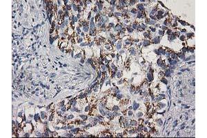 Immunohistochemical staining of paraffin-embedded Carcinoma of Human lung tissue using anti-CDK2 mouse monoclonal antibody. (CDK2 Antikörper)