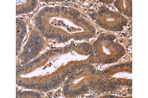 Immunohistochemistry of Human cervical cancer using CDC37L1 Polyclonal Antibody at dilution of 1:50 (CDC37L1 Antikörper)
