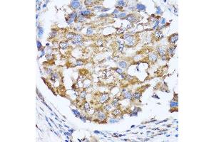 Immunohistochemistry of paraffin-embedded human breast cancer using NDE1 antibody. (NDE1 Antikörper  (AA 1-110))