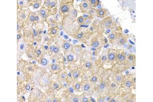 Immunohistochemistry of paraffin-embedded Human liver cancer using CRK Polyclonal Antibody at dilution of 1:200 (40x lens). (Crk Antikörper)