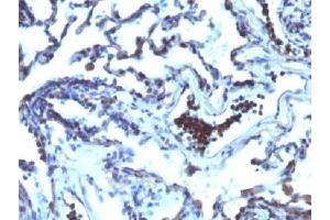 IHC testing of FFPE human lung carcinoma with TDP2 antibody (clone TDP2/1258). (TDP2 Antikörper)