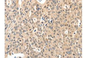 The image on the left is immunohistochemistry of paraffin-embedded Human ovarian cancer tissue using ABIN7192211(ROS1 Antibody) at dilution 1/40, on the right is treated with synthetic peptide. (ROS1 Antikörper)