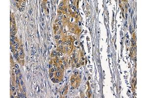 ABIN7097100 and ABIN7101167 at 1/100 staining human esophageal cancer and adjacent non-tumor tissue by IHC-P.