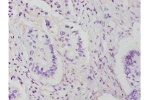 Immunohistochemistry of paraffin-embedded human colon cancer using ABIN7142748 at dilution of 1:25 (RPL14 Antikörper  (AA 2-214))
