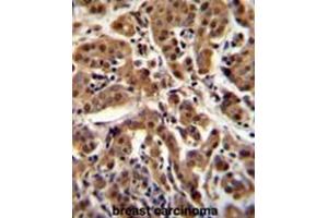 AKT1 Antibody (C-term T450) immunohistochemistry analysis in formalin fixed and paraffin embedded human breast carcinoma followed by peroxidase conjugation of the secondary antibody and DAB staining. (AKT1 Antikörper  (C-Term))