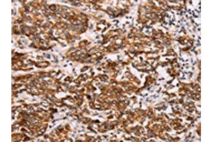 The image on the left is immunohistochemistry of paraffin-embedded Human breast cancer tissue using ABIN7192115(Rab3D Antibody) at dilution 1/27, on the right is treated with synthetic peptide. (RAB3D Antikörper)