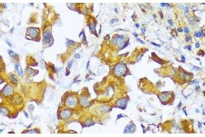Immunohistochemistry of paraffin-embedded Human lung cancer using AARS Polyclonal Antibody at dilution of 1:100 (40x lens).