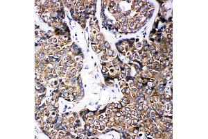 Anti-ABCB6 antibody, IHC(P) IHC(P): Human Mammary Cancer Tissue