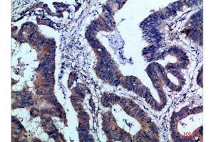 Immunohistochemical analysis of paraffin-embedded Human-colon-cancer, antibody was diluted at 1:100 (IL17F Antikörper  (AA 81-130))
