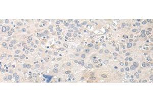 Immunohistochemistry of paraffin-embedded Human cervical cancer tissue using TUBG2 Polyclonal Antibody at dilution of 1:50(x200) (TUBG2 Antikörper)