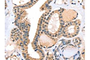 The image on the left is immunohistochemistry of paraffin-embedded Human thyroid cancer tissue using ABIN7130823(RASGEF1A Antibody) at dilution 1/20, on the right is treated with fusion protein. (RASGEF1A Antikörper)