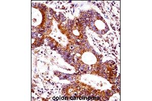 CEAC Antibody (Center) ((ABIN1537760 and ABIN2848792))immunohistochemistry analysis in formalin fixed and paraffin embedded human colon carcinoma followed by peroxidase conjugation of the secondary antibody and DAB staining. (CEACAM7 Antikörper  (AA 112-140))