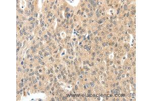 Immunohistochemistry of Human ovarian cancer using ROS1 Polyclonal Antibody at dilution of 1:40