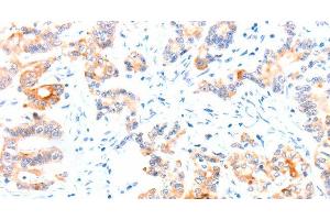 Immunohistochemistry of paraffin-embedded Human colon cancer tissue using CCDC88A Polyclonal Antibody at dilution 1:50