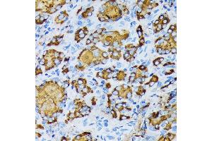 Immunohistochemistry of paraffin-embedded human thyroid cancer using γ-Tubulin Rabbit mAb (ABIN7271052) at dilution of 1:100 (40x lens).