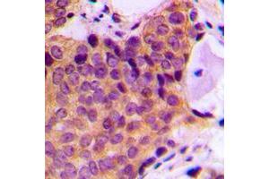 Immunohistochemical analysis of JNK1/2/3 (pT183) staining in human breast cancer formalin fixed paraffin embedded tissue section. (JNK Antikörper  (pSer183))