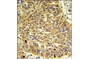 Formalin-fixed and paraffin-embedded human lung carcinoma reacted with RGP1 Antibody (C-term), which was peroxidase-conjugated to the secondary antibody, followed by DAB staining. (RGP1 Antikörper  (C-Term))