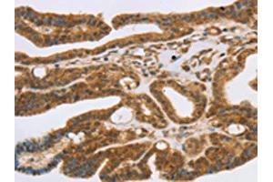 The image on the left is immunohistochemistry of paraffin-embedded Human thyroid cancer tissue using ABIN7192525(SLC7A9 Antibody) at dilution 1/35, on the right is treated with synthetic peptide.