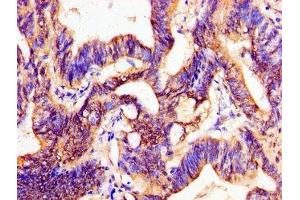 Immunohistochemistry of paraffin-embedded human colon cancer using ABIN7162750 at dilution of 1:100 (PTX3 Antikörper  (AA 99-164))