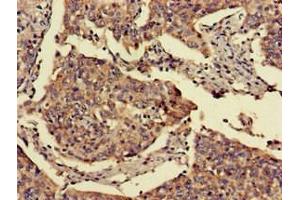 Immunohistochemistry of paraffin-embedded human cervical cancer using ABIN7153070 at dilution of 1:100 (FOXN1 Antikörper  (AA 1-160))