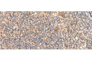 Immunohistochemistry of paraffin-embedded Human tonsil tissue using ABHD2 Polyclonal Antibody at dilution of 1:40(x200) (ABHD2 Antikörper)