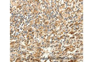 Immunohistochemistry of Human gastric cancer using SLC25A11 Polyclonal Antibody at dilution of 1:30 (SLC25A11 Antikörper)