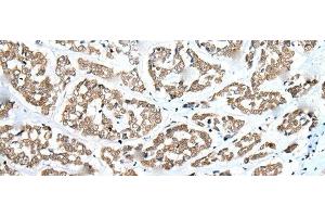 Immunohistochemistry of paraffin-embedded Human esophagus cancer tissue using ZNF248 Polyclonal Antibody at dilution of 1:25(x200) (ZNF248 Antikörper)