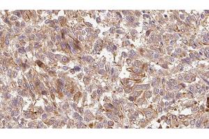 ABIN6279251 at 1/100 staining Human Melanoma tissue by IHC-P.