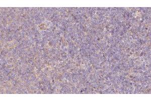 ABIN6273066 at 1/100 staining Human lymph cancer tissue by IHC-P. (PPPDE1 Antikörper  (Internal Region))