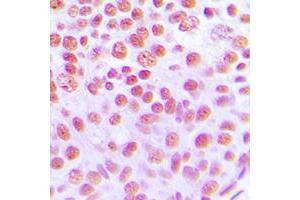 Immunohistochemical analysis of Cytokine IK staining in human breast cancer formalin fixed paraffin embedded tissue section. (Protein Red (IK) (C-Term) Antikörper)