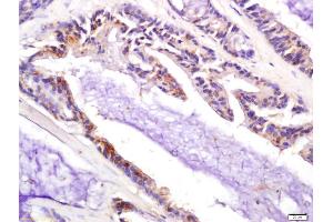 Formalin-fixed and paraffin embedded human colon carcinoma labeled with Anti-P21 Polyclonal Antibody, Unconjugated (ABIN1714474) at 1:200 followed by conjugation to the secondary antibody and DAB staining (p21 Antikörper  (AA 21-100))