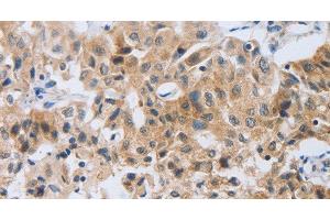 Immunohistochemistry of paraffin-embedded Human lung cancer tissue using NEB Polyclonal Antibody at dilution 1:80 (Nebulin Antikörper)