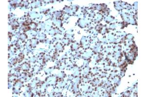 Formalin-fixed, paraffin-embedded human Ovarian Carcinoma stained with SUMO-1 Monoclonal Antibody (SUMO1/1188) (SUMO1 Antikörper)