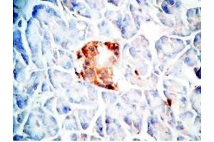 Human pancreas cancer tissue was stained by Rabbit Anti-Oxyntomodulin (H,M,R) Antibody (OXM Antikörper)