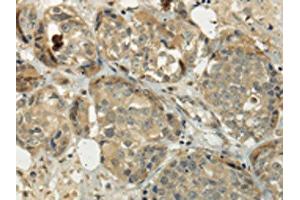 The image on the left is immunohistochemistry of paraffin-embedded Human breast cancer tissue using ABIN7128017(SIAH1 Antibody) at dilution 1/35, on the right is treated with fusion protein. (SIAH1 Antikörper)