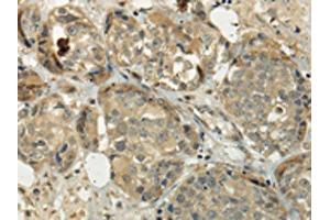 The image on the left is immunohistochemistry of paraffin-embedded Human breast cancer tissue using ABIN7128017(SIAH1 Antibody) at dilution 1/35, on the right is treated with fusion protein.