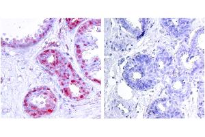 P-Peptide - +Immunohistochemical analysis of paraffin-embedded human breast carcinoma tissue using c-Jun (phospho-Ser243) antibody. (C-JUN Antikörper  (pSer243))
