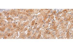 Immunohistochemistry of paraffin-embedded Human liver cancer tissue using GPC4 Polyclonal Antibody at dilution of 1:30(x200) (GPC4 Antikörper)