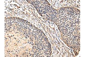 The image on the left is immunohistochemistry of paraffin-embedded Human esophagus cancer tissue using ABIN7128083(VIP Antibody) at dilution 1/20, on the right is treated with fusion protein.
