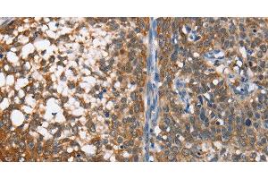 Immunohistochemistry of paraffin-embedded Human cervical cancer using MAD2L1BP Polyclonal Antibody at dilution of 1:65 (MAD2L1BP Antikörper)