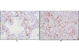 Immunohistochemical analysis of paraffin-embedded human lung cancer (A), lymphonodus tissue (B),showing cytomembrane localization using CD38 antibody with DAB staining. (CD38 Antikörper)