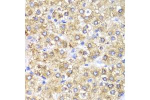 Immunohistochemistry of paraffin-embedded human liver cancer using SHMT2 antibody at dilution of 1:100 (400x lens). (SHMT2 Antikörper)