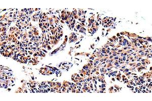 Immunohistochemistry of paraffin-embedded Human lung cancer using AKR1B1 Polyclonal Antibody at dilution of 1:40 (AKR1B1 Antikörper)