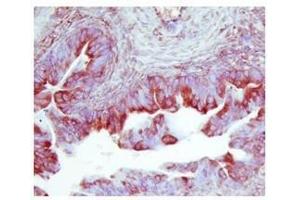 TIMP2 in human ovarian cancer was detected using HRP/AEC red color stain (TIMP2 Antikörper  (Middle Region))