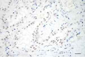 Immunohistochemistry was performed on paraffin-embedded human lung adenocarcinoma using ADAM17 antibody (ABIN7797502), 1:200). (Rekombinanter ADAM17 Antikörper)