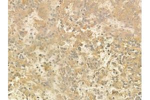 ABIN6260454 and ABIN6272856 at 1/100 staining human melanoma by IHC-P.